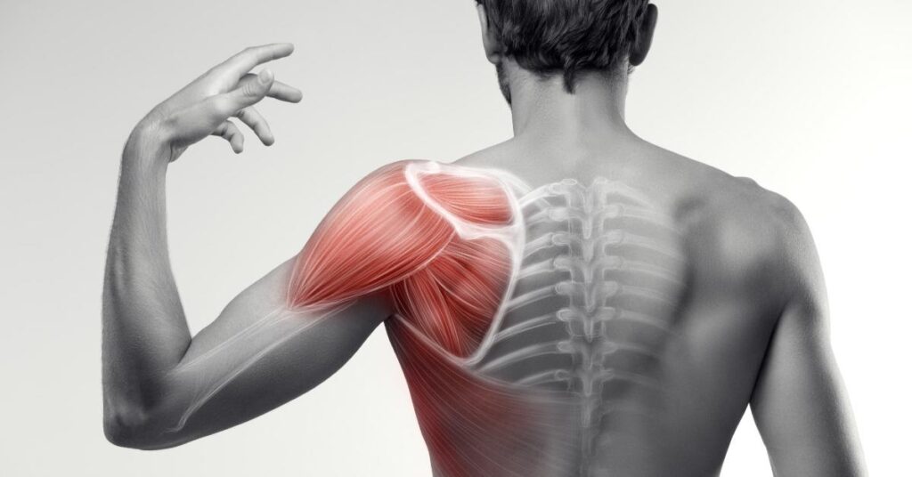 Schouderklachten door impingement met aanduiding van beknelde zachte weefsels tussen botten