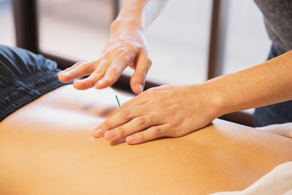 Dry needling behandeling met dunne steriele naald voor het aanpakken van spierknopen en triggerpoints